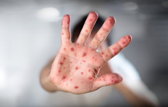 هشدار وزارت بهداشت درباره شیوع سرخک هشدار وزارت بهداشت درباره شیوع سرخک