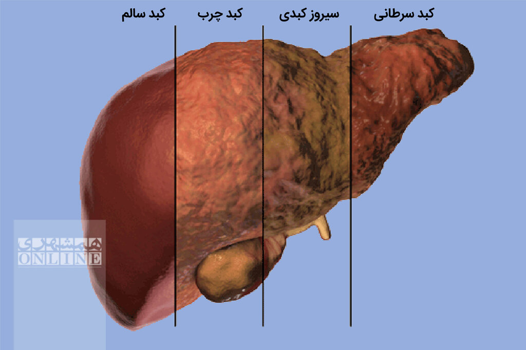 علایم کبد چرب را بشناسید علایم کبد چرب را بشناسید