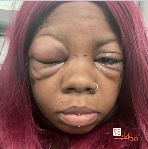 عاقبت تاتو کردن داخل چشم عاقبت تاتو کردن داخل چشم