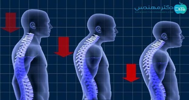 رفع قوز کمر در یک هفته با تیم دکتر مهندس رفع قوز کمر در یک هفته با تیم دکتر مهندس