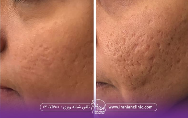 قیمت اندولیفت در سال ۱۴۰۳ چقدر است؟ قیمت اندولیفت در سال ۱۴۰۳ چقدر است؟