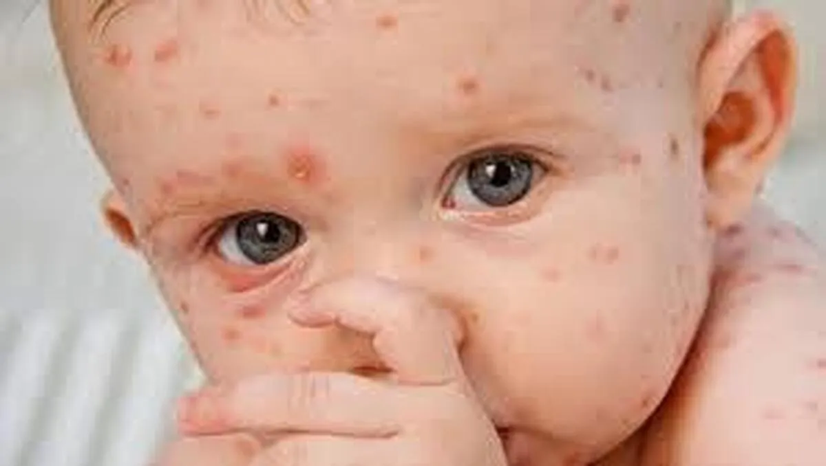 راه‌های انتقال ویروس آبله مرغان چیست؟