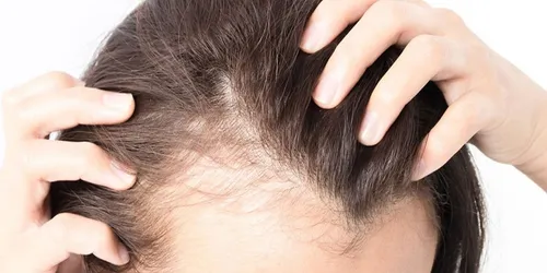 جلوگیری از ریزش مو با این توصیه ساده طب&zwnj;سنتی