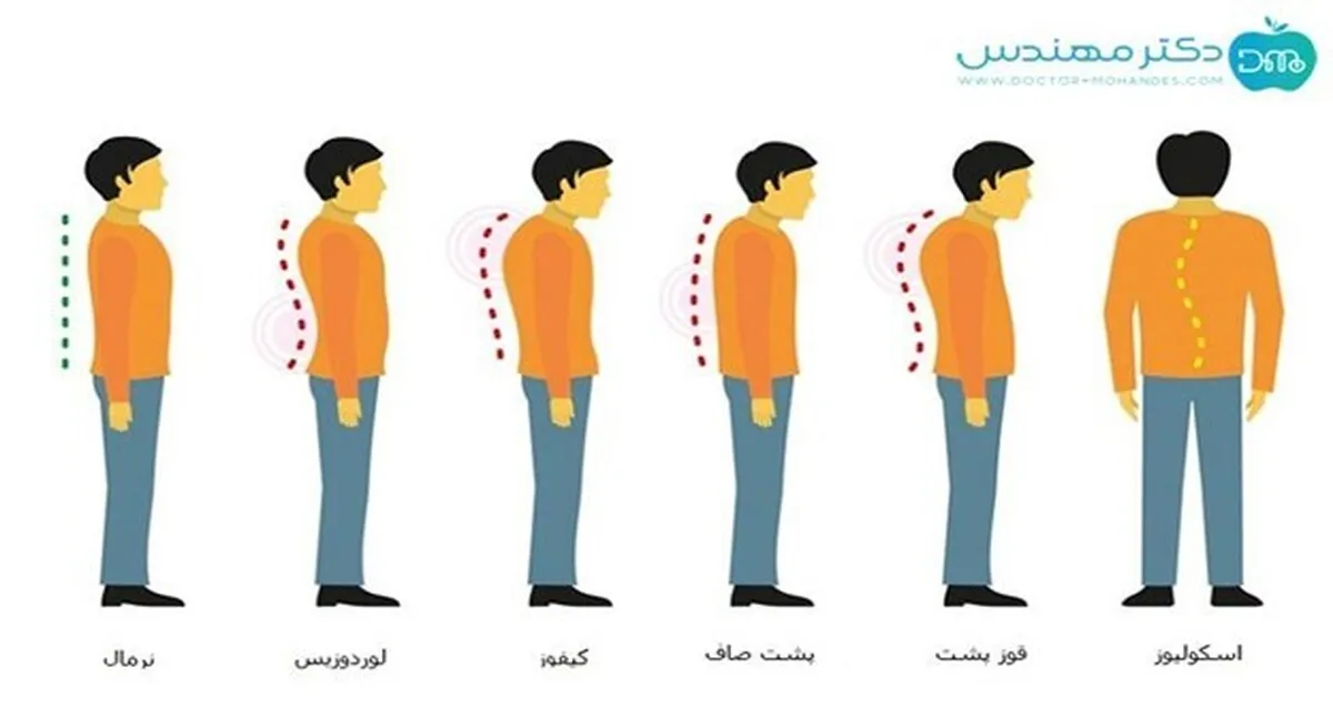 رفع قوز کمر در یک هفته با تیم دکتر مهندس