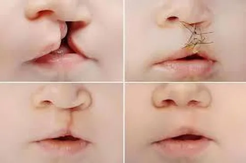 شکاف کام چیست و چگونه درمان می&zwnj;شود؟