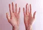 ارتباط مرموز «بیماری وایکینگ» با دی‌ان‌ای نئاندرتال
